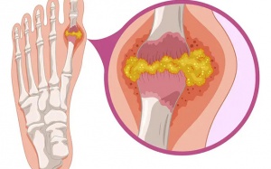 Nguy cơ từ các hạt tophi do bệnh gout  