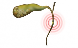 Có sỏi ống mật chủ 22mm cần xử trí thế nào?