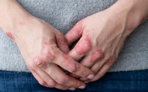 Giải pháp cho người vảy nến đang điều trị bệnh dạ dày