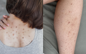 Giải pháp giúp làn da cơ thể mịn màng, hết mụn