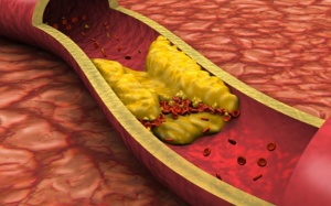 5 cách cải thiện mỡ máu cao hiệu quả