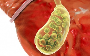 Có đám sỏi mật 27mm phải làm sao?