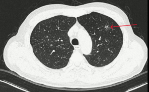 Đi khám sỏi thận, phát hiện ung thư phổi giai đoạn sớm nhờ AI