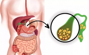 Sỏi túi mật 7,5mm có nguy hiểm không?