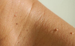 5 dấu hiệu cảnh báo bệnh đái tháo đường bạn không nên bỏ qua