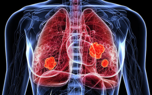 Những dấu hiệu cảnh báo u phổi ác tính không nên bỏ qua