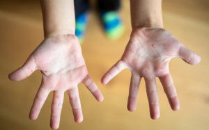 Cha mẹ cần cảnh giác với bệnh tay chân miệng ở trẻ