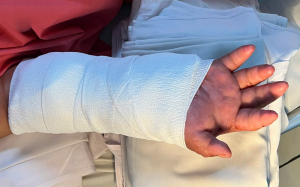 Nối lại bàn tay đứt lìa cho sản phụ, sau 2 tháng được 'ghép tạm' vào chân