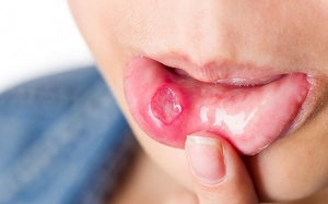 Dấu hiệu ở miệng chứng tỏ bạn thiếu vitamin B12