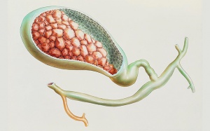 Sỏi mật 8,9mm và 15mm chưa có biến chứng có nguy hiểm không?