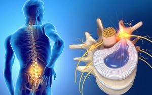 7 nguyên nhân dẫn đến thoát vị đĩa đệm