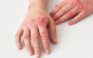 Người bệnh lupus ban đỏ nên ăn gì để kiểm soát triệu chứng tốt?