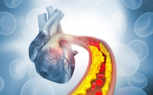 Tăng huyết áp kèm cholesterol cao: “Bộ đôi” đẩy nhanh xơ vữa mạch