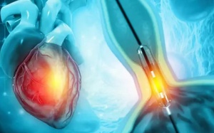 Hẹp mạch vành sau khi điều trị có tự hồi phục hoàn toàn không?