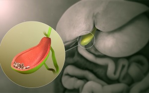 Tán sỏi qua da dễ tái phát phải làm sao?