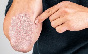 Chìa khóa giúp người bệnh vảy nến ổn định triệu chứng lâu dài