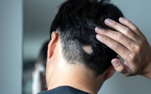 Lầm tưởng thường gặp về chứng rụng tóc từng mảng