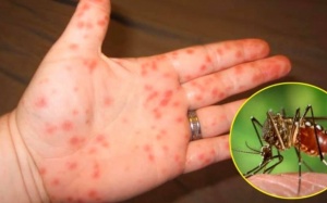 Sốt xuất huyết, tay chân miệng nặng tăng cao, Bộ Y tế cảnh báo khẩn