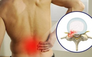 Thói quen hàng ngày khiến bệnh thoát vị đĩa đệm nặng hơn
