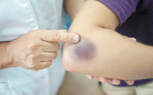 Dễ bị bầm tím, vì bạn đang thiếu loại vitamin này 