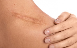 Cùng là vết thương, vì sao mặt ít sẹo hơn cơ thể?