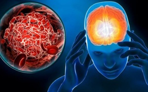 Nguyên nhân tai biến mạch máu não và cách phòng ngừa hiệu quả