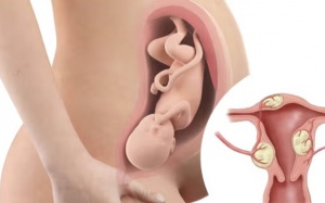 U xơ tử cung có gây khó mang thai không?