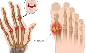 Chế độ ăn uống giúp giảm acid uric