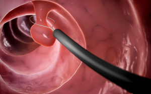 5 cách bảo vệ đại tràng, hạn chế nguy cơ ung thư từ polyp