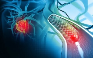 Sau can thiệp đặt stent mạch vành: Bao lâu có thể làm việc trở lại?