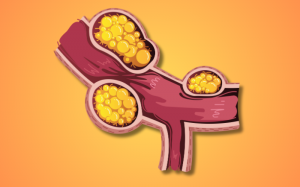 Xơ vữa động mạch: Nguyên nhân, mức độ nguy hiểm và giải pháp hỗ trợ phòng ngừa