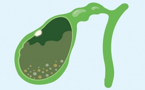 Có polyp túi mật và sỏi bùn túi mật cần cẩn trọng gì?