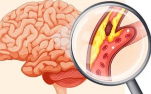 Những ai dễ bị nhồi máu não?