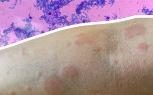 Lupus ban đỏ dạng đĩa ảnh hưởng thế nào đến cơ thể và làn da?