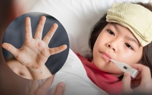 Bệnh thủy đậu là gì và cách điều trị ra sao? 