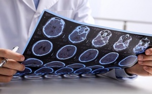 3 yếu tố làm tăng nguy cơ tử vong do bệnh đa xơ cứng