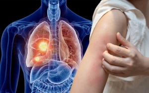 Dấu hiệu ngoài da cảnh báo u phổi