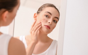 Infographic: Tại sao người trưởng thành vẫn có thể bị mụn?