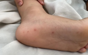 Ca bệnh tay chân miệng tăng gấp 5 lần, Bộ Y tế yêu cầu siết chặt kiểm soát