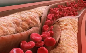 Xơ vữa động mạch hình thành như thế nào?  