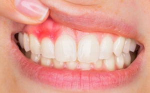 Mách bạn 5 cách cải thiện viêm lợi tại nhà