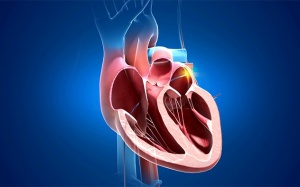 Đốt điện tim rồi vẫn tái phát, có nên tiếp tục can thiệp hay chuyển hướng khác?