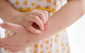 Giải pháp thảo dược cho trẻ bị nổi mề đay