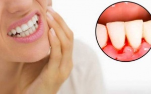 Chảy máu chân răng cảnh báo bệnh gì?