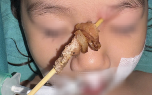 Bé gái 2 tuổi suýt mù mắt, tổn thương não khi ăn thịt xiên nướng