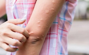 Nổi mề đay mùa Hè, phải làm sao?