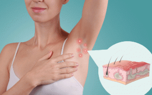 Sống chung với viêm tuyến mồ hôi mủ trong mùa Hè