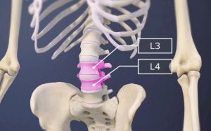 Dấu hiệu nhận biết thoát vị đĩa đệm L3 L4