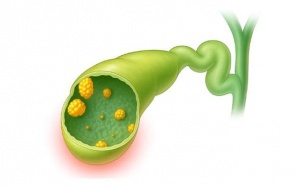 Polyp túi mật 14mm có nguy hiểm không?