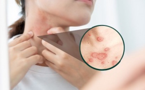 Lupus ban đỏ dạng đĩa có nguy hiểm không? 